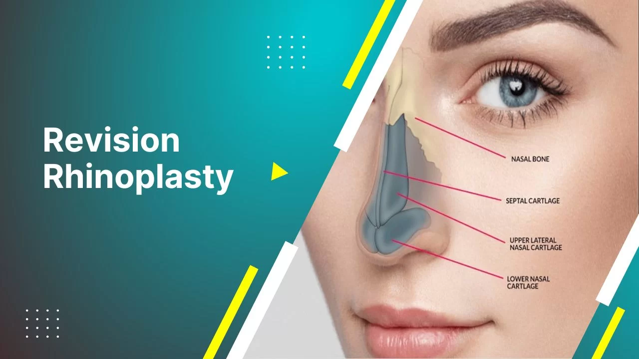 Rhinoplasty in Dubai: Addressing Nasal Valve Collapse