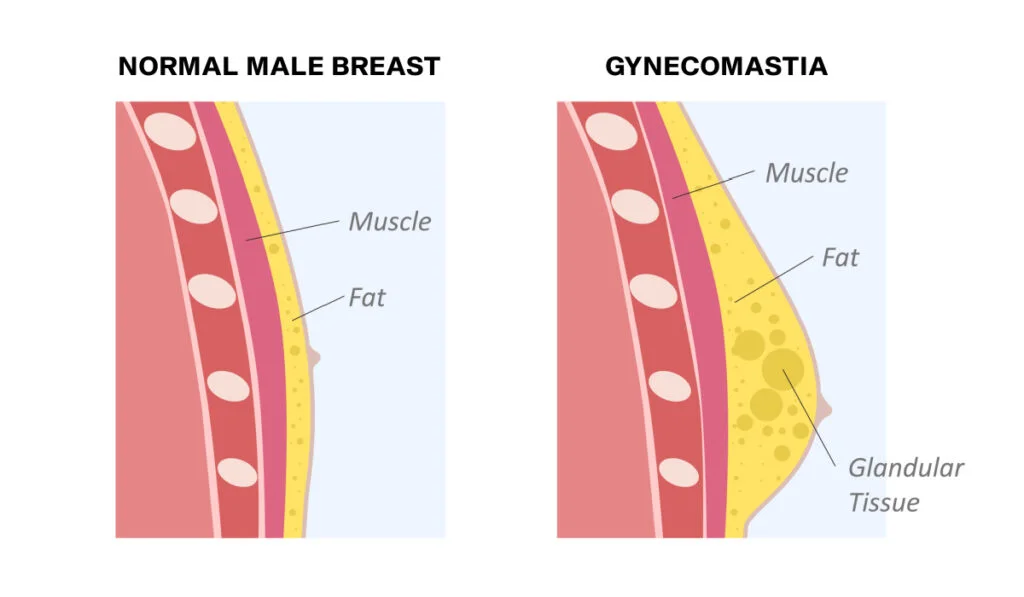 Male Breast Reduction Surgery for Teenagers